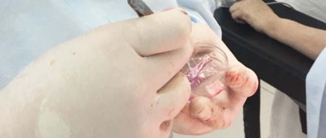 ИА ЯСИА – Якутские медики впервые выполнили пересадку кожи, выращенную из стволовых клеток пострадавшего